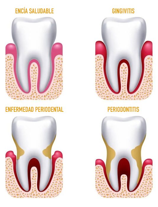 Esquema-peridontitis