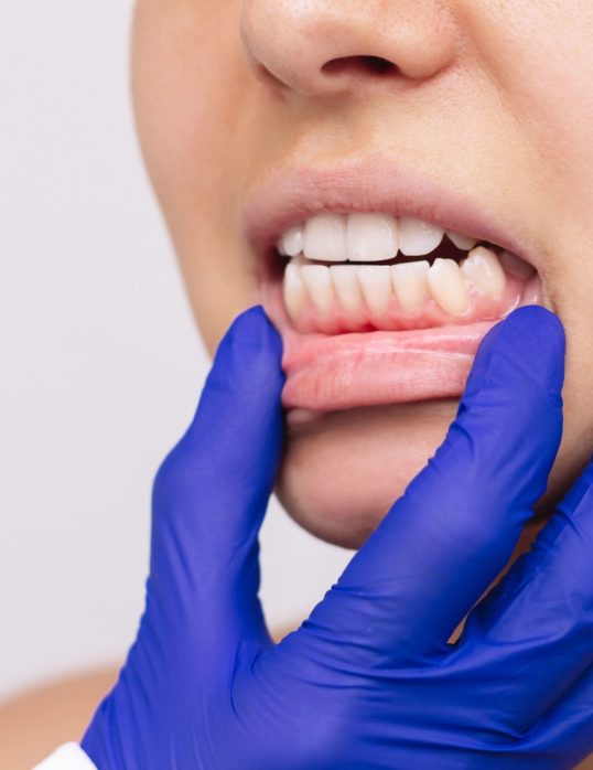 wrong-bite-young-woman-s-face-with-doctor-s-hand-blue-glove-showing-healthy-gums-malocclusion